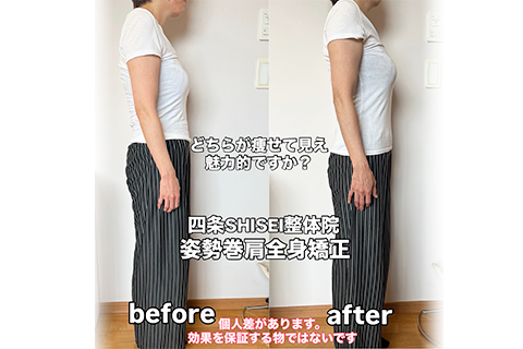 矯正ビフォーアフター